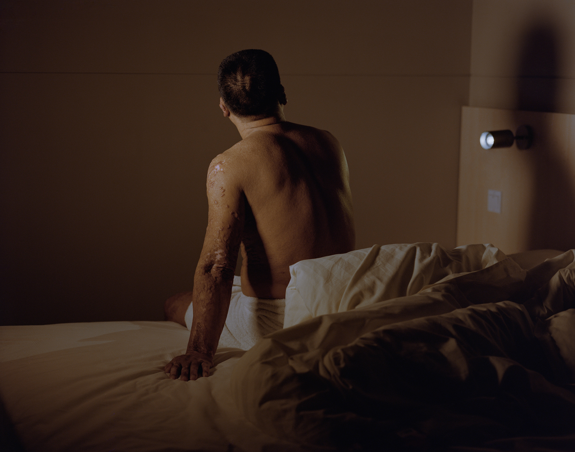 Su Tieqiang, a former coal miner with Hengda Mining Company and a survivor of a 2014 fire ignited by coal dust, sits in a hotel room near the hospital where he receives treatment, in Fuxin. 26 of his co-workers died in the fire. Fuxin has over 200 mines, mostly coal mines, and mining accidents have been a painful feature of daily life for its inhabitants. In 2005, a gas explosion at Sunjiawan Mine claimed 214 lives.